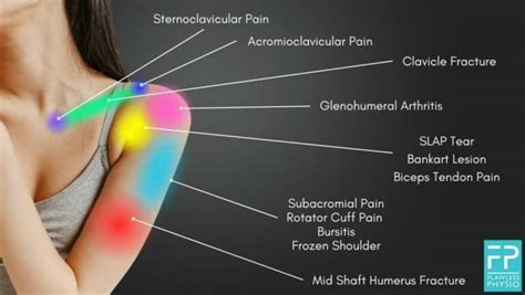 Shoulder Pain Diagnosis Chart | Shoulder Pain Location Chart