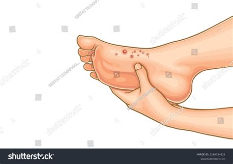 Vector Illustration Woman Feet Pustules On Stock Vector (Royalty Free) 2280784921 | Shutterstock