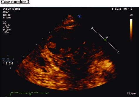 Echocardiography showed apical thrombus 5.3 Â 1.7 cm in size ...