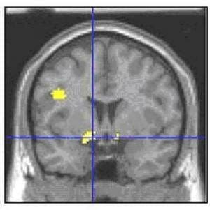 Bipolar Brain Imaging Provides a Major Breakthrough | Bipolar Lives