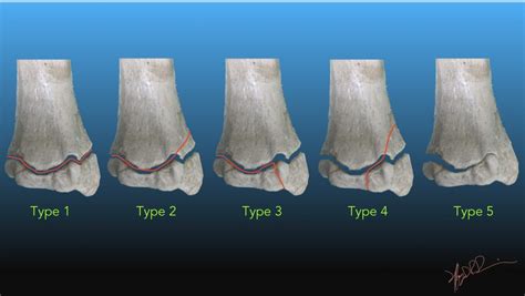 Salter-Harris Classification of Growth Plate Fractures | UW Emergency Radiology