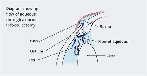 Trabeculectomy Surgery | Glaucoma Treatments | Glaucoma UK