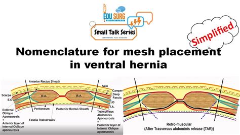 Hernia Prophylactic Mesh Placement To Avoid Incisiona - vrogue.co