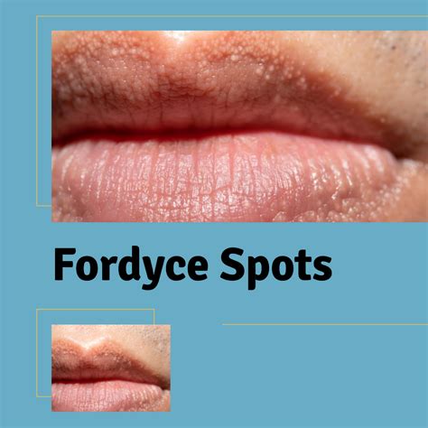 Get Rid Of Fordyce Spots On Lips Reddit - Infoupdate.org