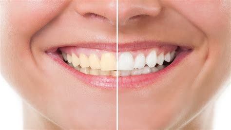 teeth whitening home remedies for yellow teeth use these tips health ...