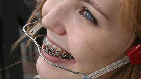 Laura Orthodontic Braces with High Pull Headgear and Milwaukee Brace ...