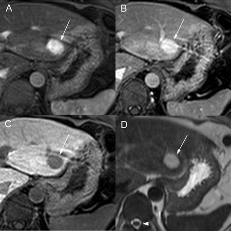 LI-RADS: not so easy! - European Radiology