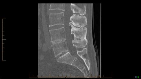 Radiology Cases: Baastrup's Disease