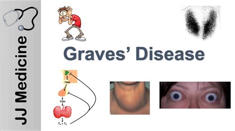 Graves Disease and Graves Ophthalmopathy | Signs, Symptoms, Diagnosis ...