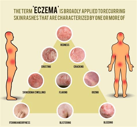 Brief Guidance on Different Types of Eczematous Dermatitis - Basic Baby care, tips, products and ...