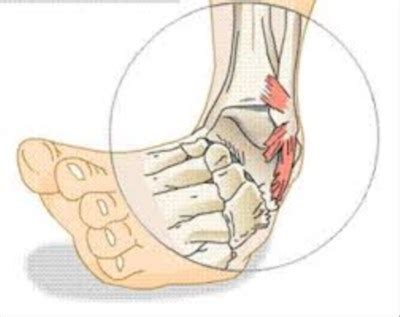 Ankle distorsion/sprain - 1st degree, Ankle joint injuries and damage | Videoreha - medical and ...