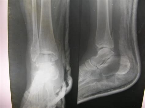 X-rays and Slides: Fracture lateral malleolus of tibia with plaster splint