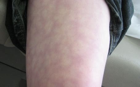 Erythema ab Igne (Toasted skin syndrome, fire stains, ephelis ignealis, erythema ab calore)