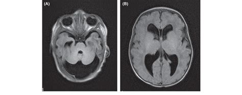 (A) Cranial MRI shows cerebellar hypoplasia. (B) Cranial MRI shows ...