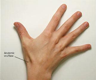 Scaphoid Fracture - Hand - Orthobullets