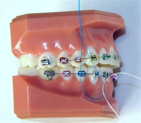 How Do You Floss with Braces? | Ask an Orthodontist.com