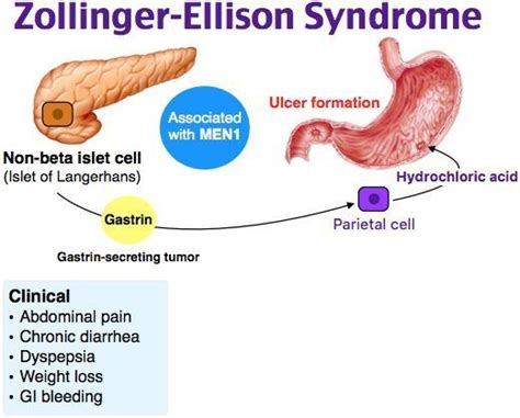 Zollinger - Ellison syndrome - GI - tumor - gastrin - Surgery | Gastrointestinal disorders ...