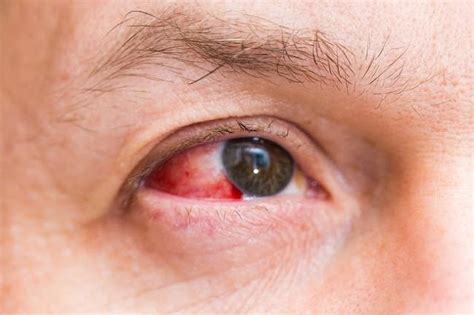 Red spots on the eyes due to subconjunctival bleeding, this is the cause and cure