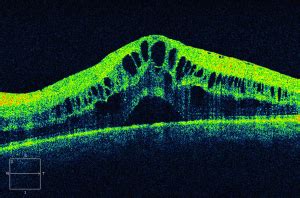 Cystoid Macular Edema