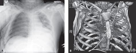 95 Flail Chest | Radiology Key