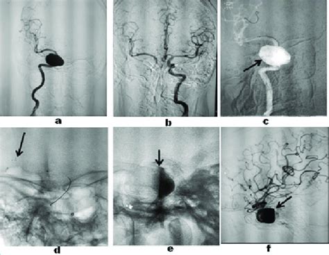 a) A 2-D right ICA angiogram shows a giant right cavernous ICA aneurysm ...