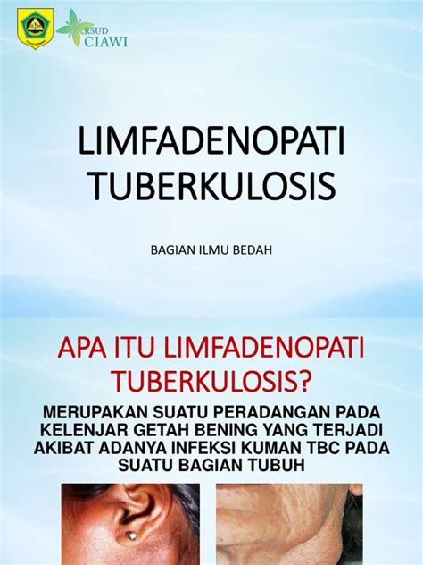 Limfadenopati Tuberkulosis Penyuluhan | PDF