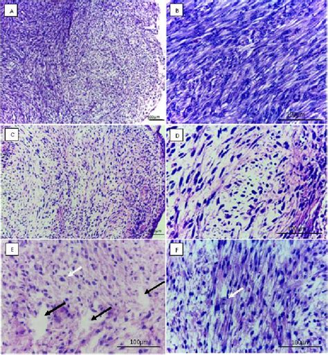 Histology of glioblastoma multiforme tumour cultured on chorioallantoic ...