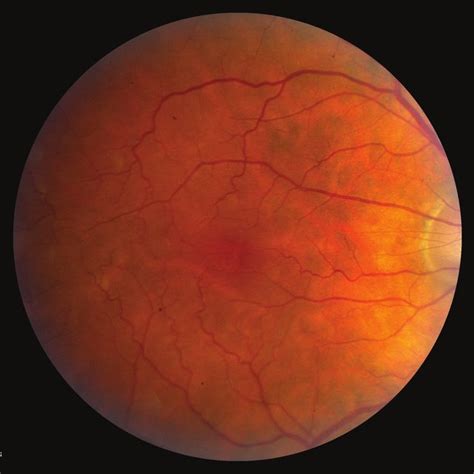 a Color photograph of a normal macula. The normal retinal vasculature ...