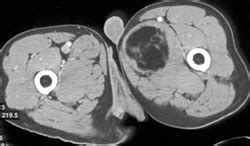 Liposarcoma - Musculoskeletal Case Studies - CTisus CT Scanning