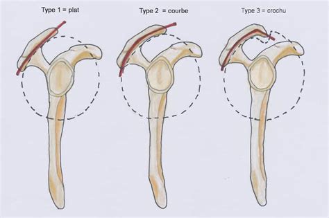 Acromion Types