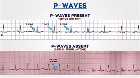 How to Read an ECG | ECG Interpretation | EKG | Geeky Medics