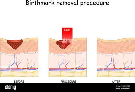 Birthmark laser Removal. Treatment. Before and after procedure Stock Vector Image & Art - Alamy