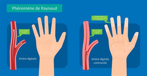 What Is Raynaud's Disease?