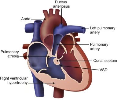 Tetralogy of Fallot with Pulmonary Atresia | Radiology Key