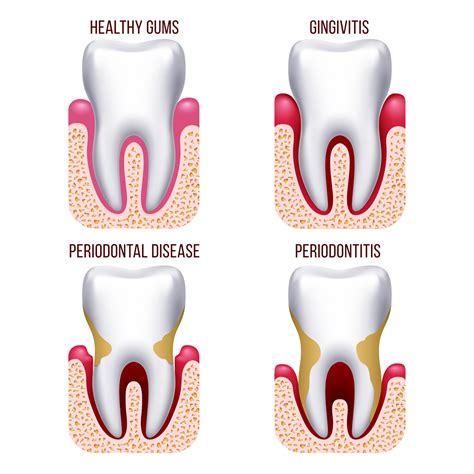 Bleeding Gums - Causes, Symptoms, Treatment | Ear, Nose, Throat, and Dental problems articles ...