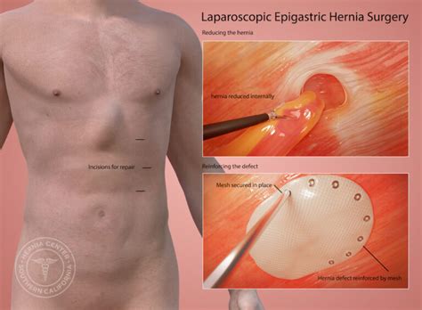 Epigastric Hernia Treatment Pasadena Los Angeles Orange County CA