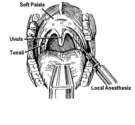 Uvulopalatopharyngoplasty - wikidoc