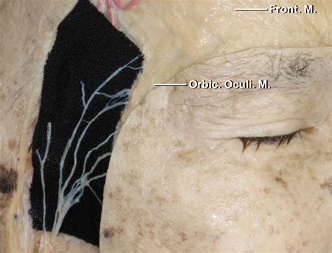 Pterional Craniotomy | The Neurosurgical Atlas