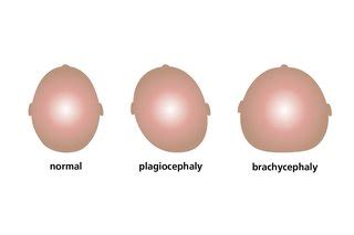 Plagiocephaly and brachycephaly (flat head syndrome) - NHS