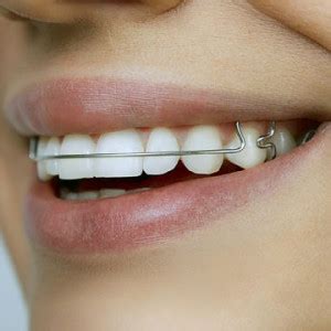 Straight Wire Braces help in Straight Teeth - Dr Sunil Dental Blog