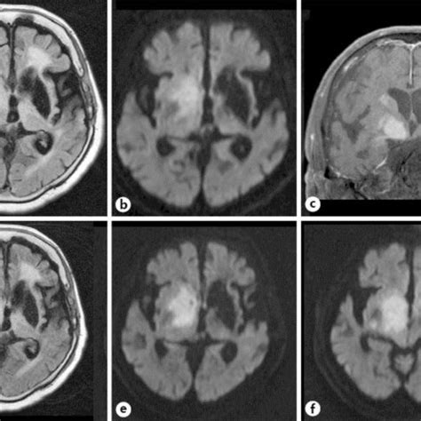 Brain MRI in the 7th (a–c) and 9th (d–f) week after admission. FLAIR ...