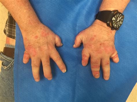 It’s Pop Quiz Friday 8/31! Let’s see if you get it right! - Next Steps in Dermatology