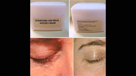 Syringoma and Milia buster cream - YouTube