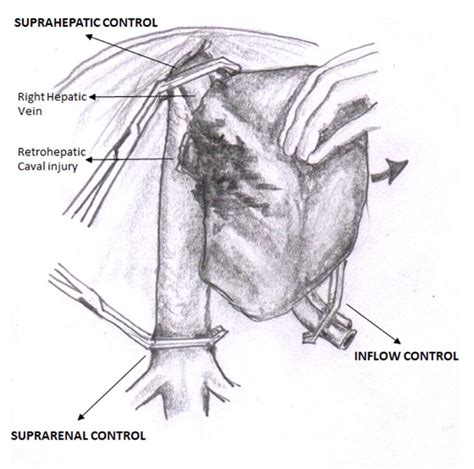 Cirbosque #SoMe4Surgery on Twitter: "Triple vascular control and exposure of the Supra renal ...