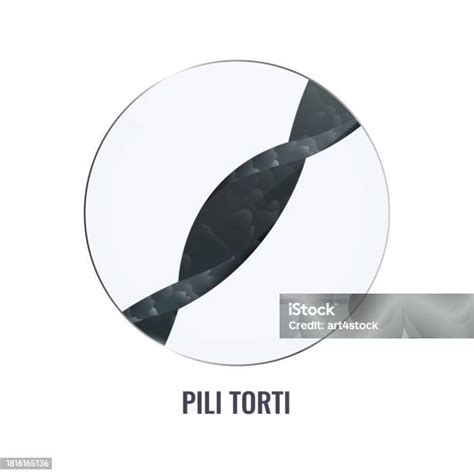 Pili Torti Hair Disorder In Close Up Stock Illustration - Download Image Now - Anatomy ...