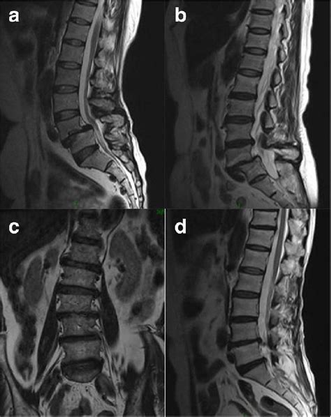 Lumbar Spine Degeneration