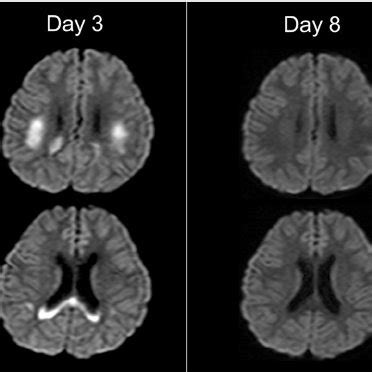 MRI of patient 2. On day 3, diffusion-weighted images reveal lesions in... | Download Scientific ...