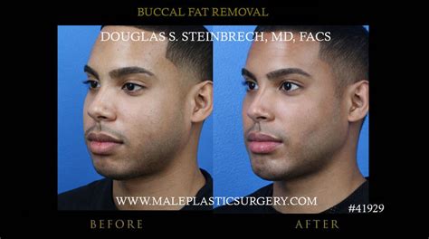 Buccal Fat Removal - Male Plastic Surgery Chicago