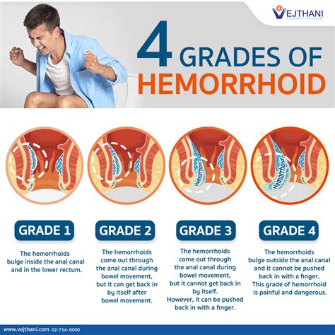 Do you have hemorrhoids? How severe is your hemorrhoid?