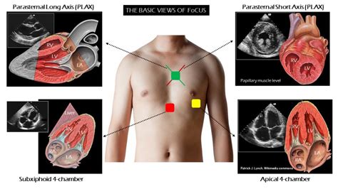 Introduction to Focused Cardiac Ultrasound: The Parasternal Long Axis ...